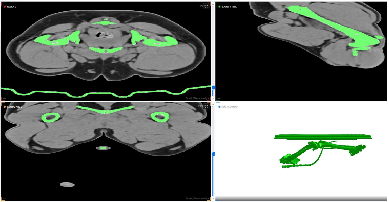 Interfaccia AIMED3D Anatomy con viste assiale, sagittale, coronale e modello 3D segmentato