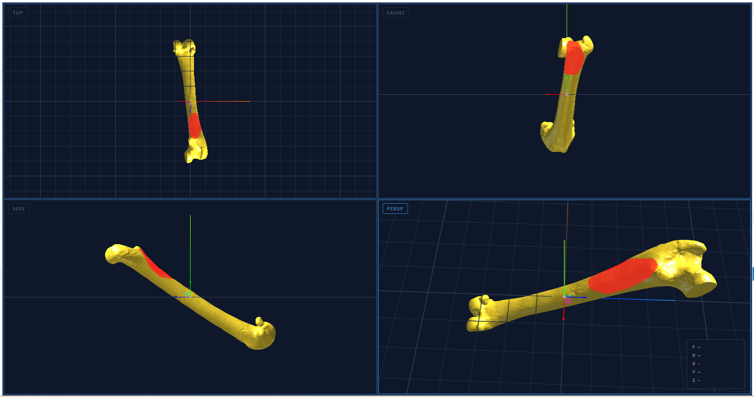 Interfaccia AIMED3D Design con viste top, front, side e prospettica di un femore in fase di progettazione