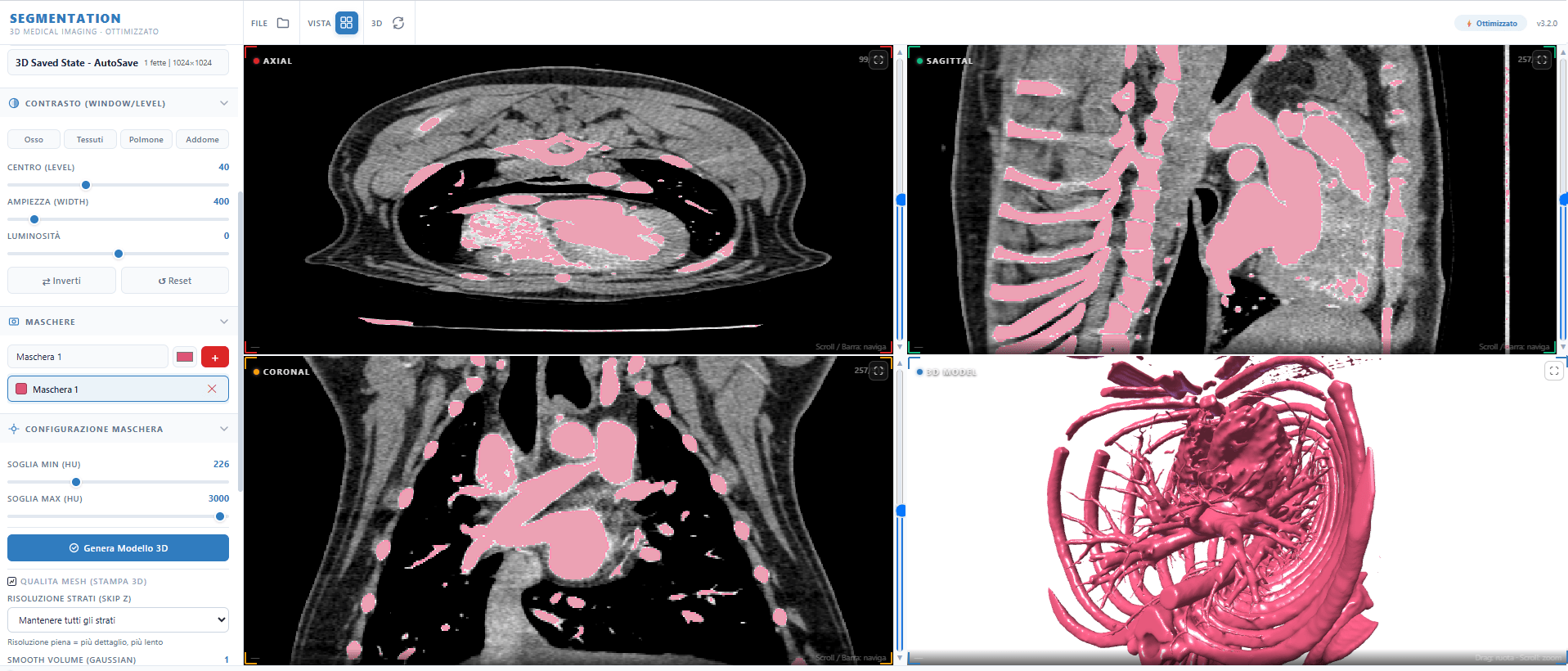 Interfaccia del software AIMED3D Segmentation con viste assiale, sagittale, coronale e modello 3D del torace