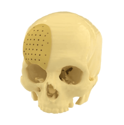 Resin Biomedical DLP - modello cranico con innesto per pianificazione chirurgica