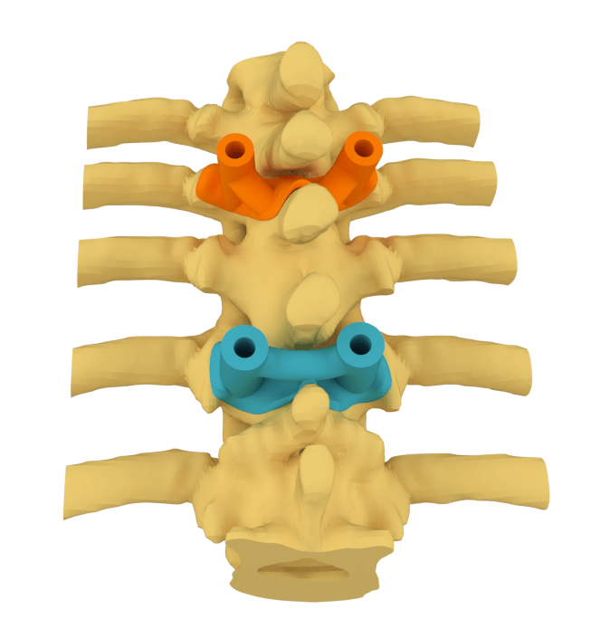 Guide chirurgiche personalizzate per il posizionamento di viti pediculari su modello vertebrale 3D