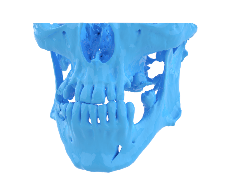Modello 3D stampato di cranio e struttura maxillo-facciale