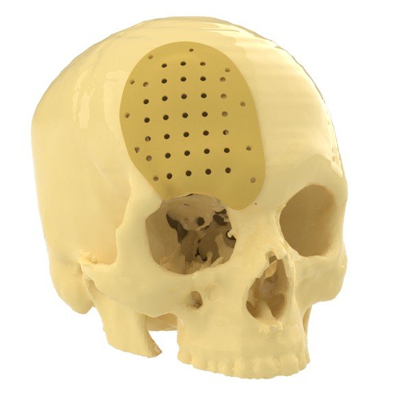Impianto cranico personalizzato stampato in 3D